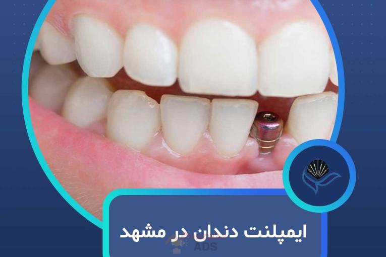 ایمپلنت دندان در مشهد با اقساط بلندمدت و شرایط ویژه